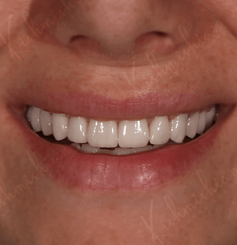 Ցիրկոն-կերամիկական շապիկներ