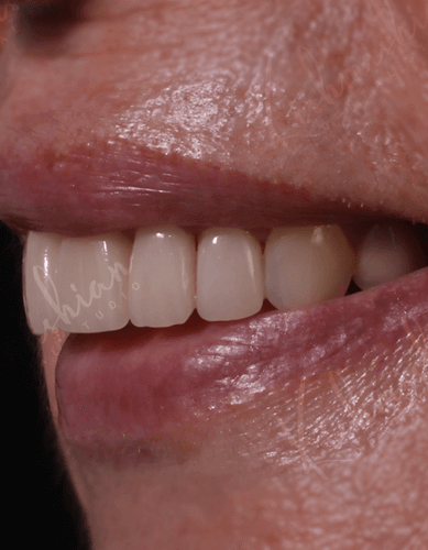 Veneers