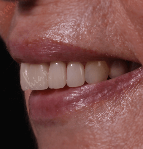 Veneers