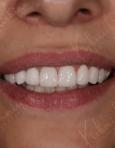 Կերամիկական շապիկներ