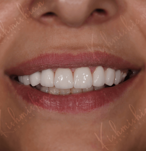 Կերամիկական շապիկներ