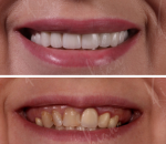 ցիրկոն-կերամիկական շապիկներ